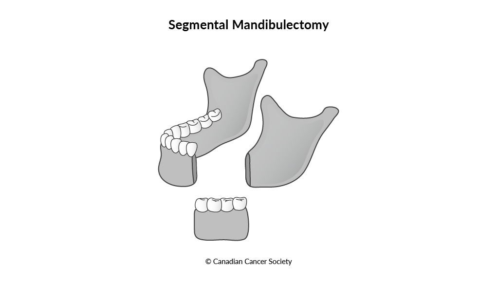 Diagram of segmental mandibulectomy
