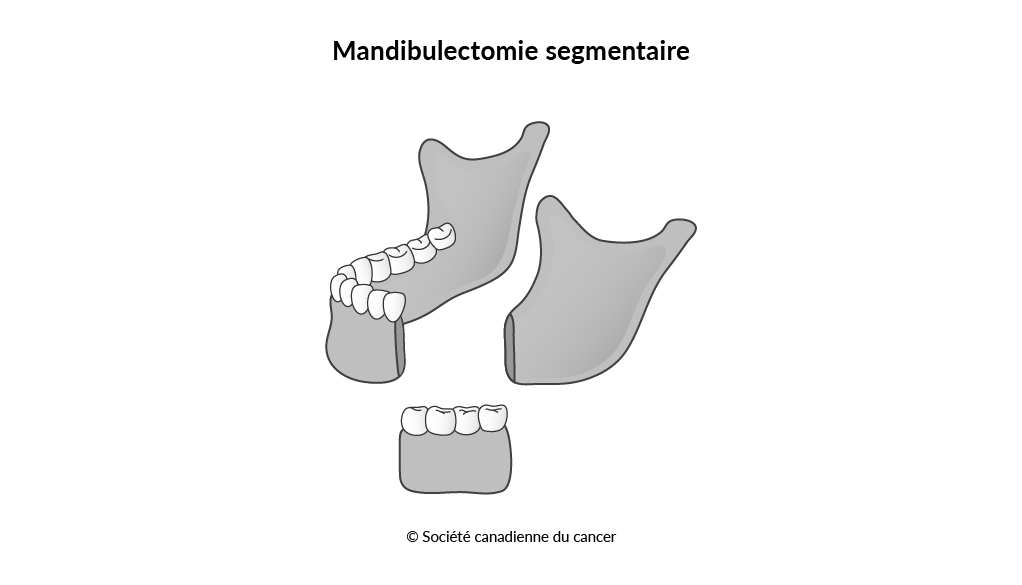 Schéma de la mandibulectomie segmentaire