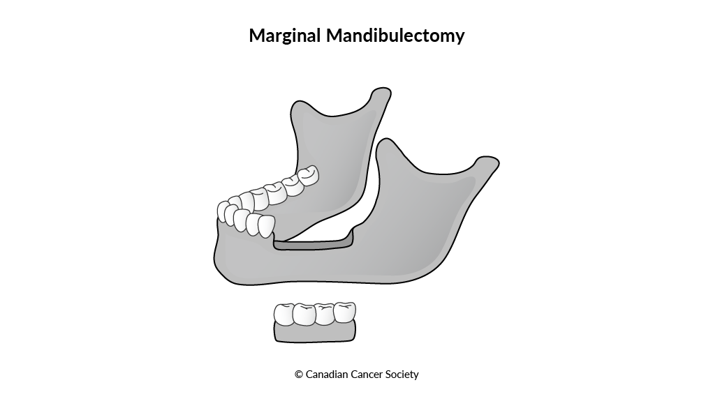 Diagram of marginal mandibulectomy