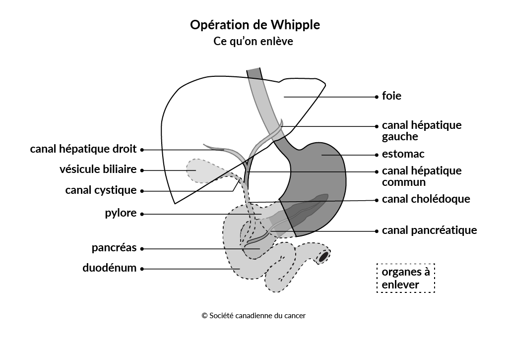 Diagramme montrant les tissus et les organes enlevés lors de l’opération de Whipple.