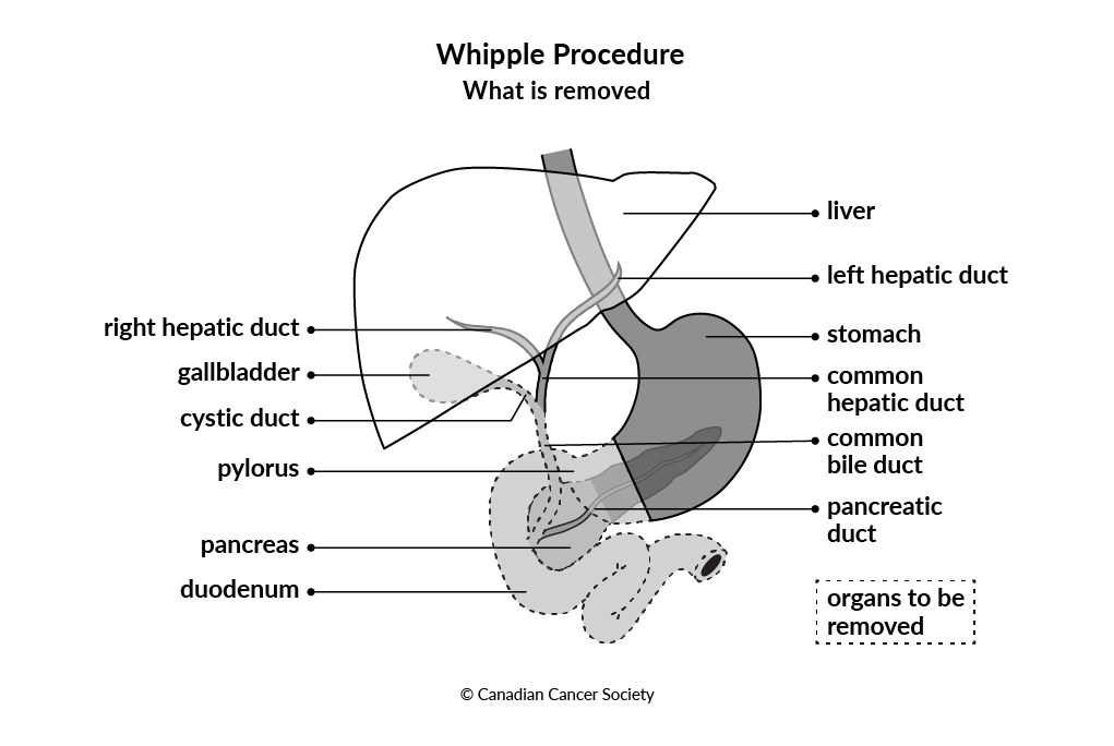 Diagram of Whipple Procedure what is removed