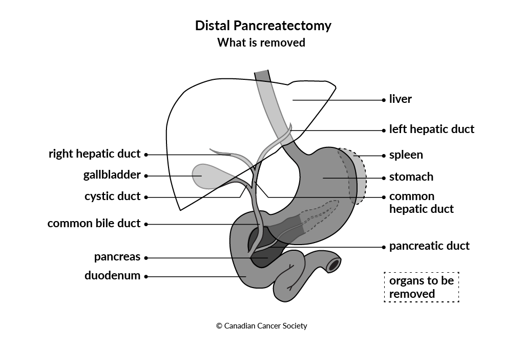 Diagram showing what tissues and organs are removed during a distal pancreatectomy surgery