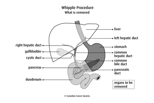 Diagram of Whipple Procedure what is removed
