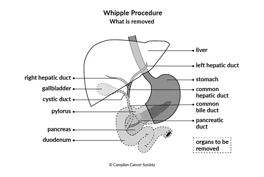 Diagram of Whipple Procedure what is removed
