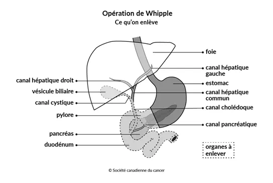 Diagramme montrant les tissus et les organes enlevés lors de l’opération de Whipple.