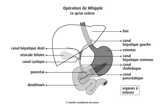 Schéma de l'opération de Whipple