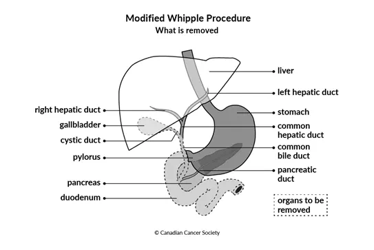 Diagram of Modified Whipple Procedure what is removed