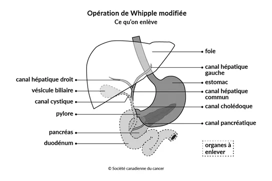 Schéma de ce qu'on enlève lors de l'opération de Whipple modifiée