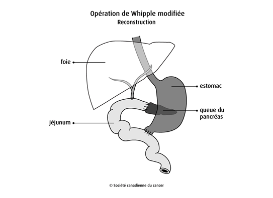 Schéma de la reconstruction lors de l'opération de Whipple modifiée