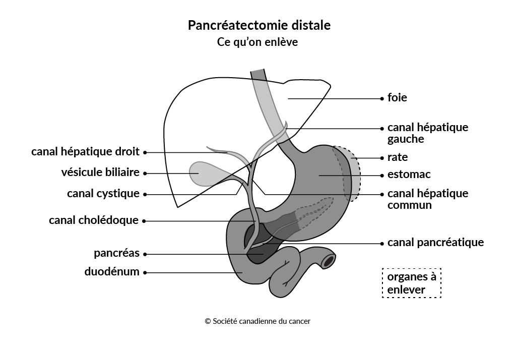 Diagramme montrant les tissus et les organes enlevés lors de la pancréatectomie distale.