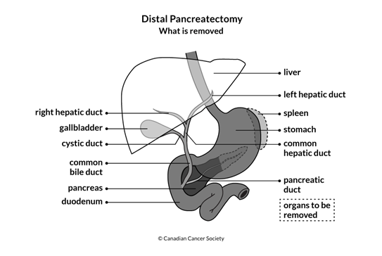 Diagram of Distal Pancreatectomy what is removed