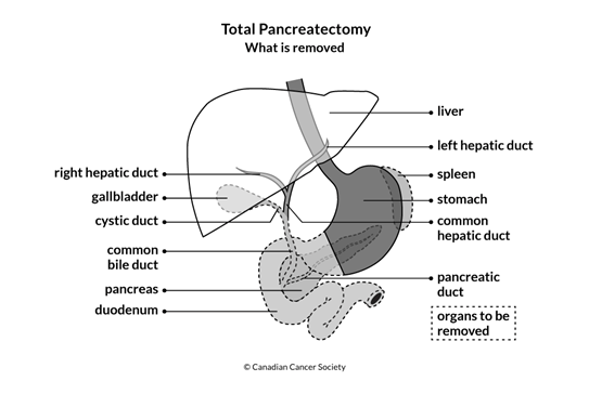 Diagram of Total Pancreatectomy what is removed