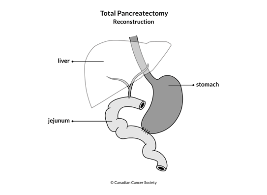 Diagram of Total Pancreatectomy Reconstruction