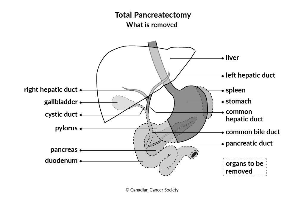 Diagram showing what tissues and organs are removed during a total pancreatectomy surgery