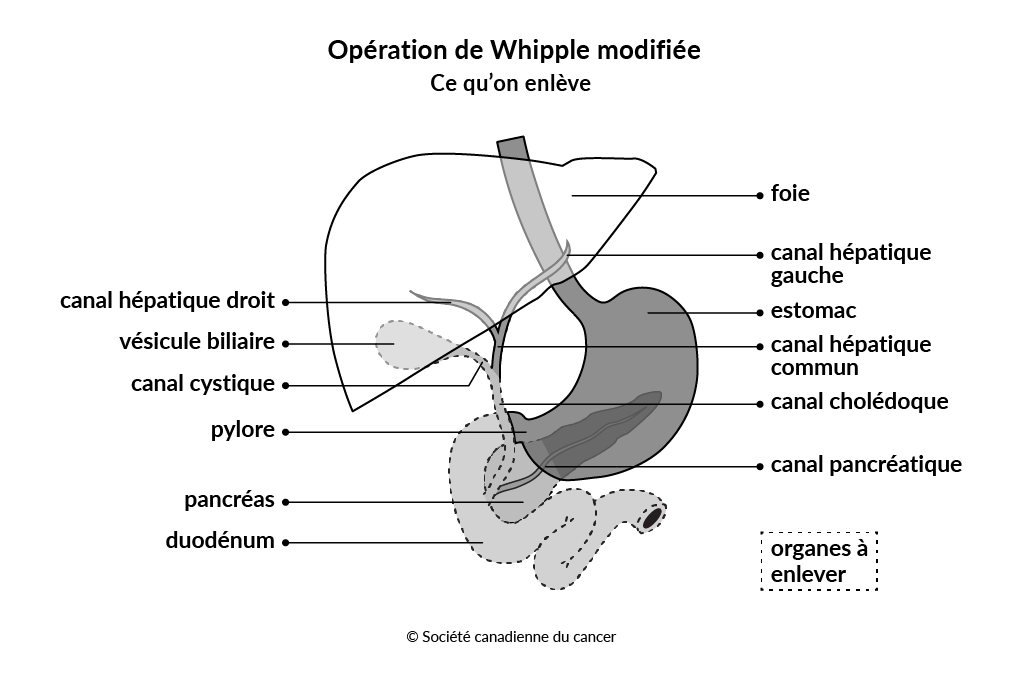 Diagramme montrant les tissus et les organes enlevés lors de l’opération de Whipple modifiée.