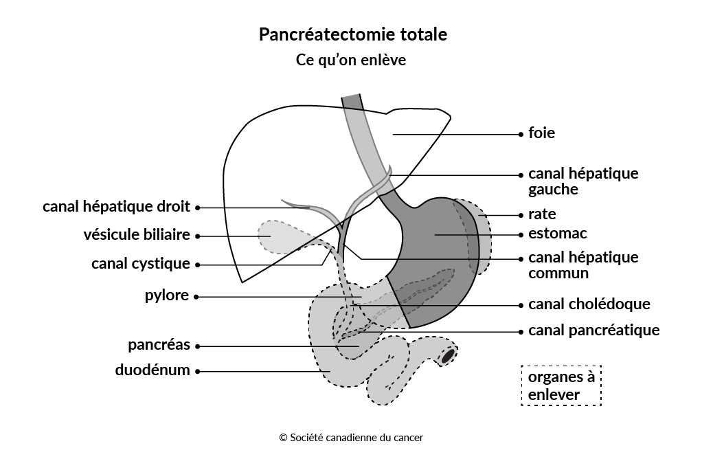 Diagramme montrant les tissus et les organes enlevés lors de la pancréatectomie totale.