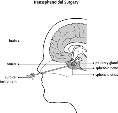 Diagram of transsphenoidal surgery