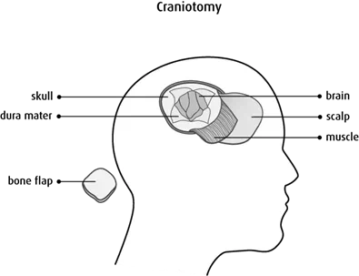 Diagram of a craniotomy