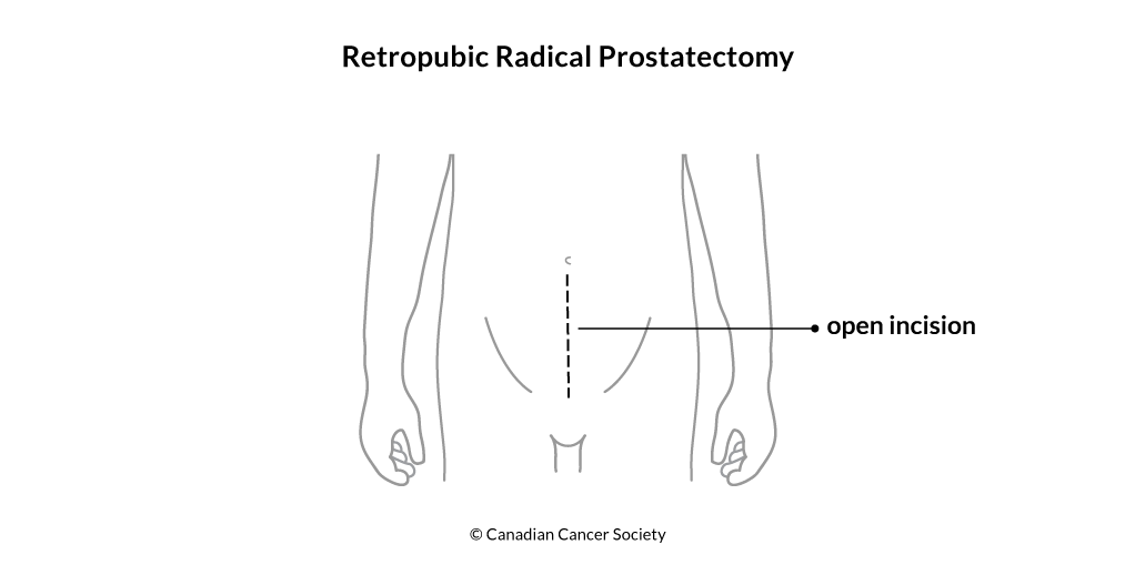 Diagram of retropubic radical prostatectomy