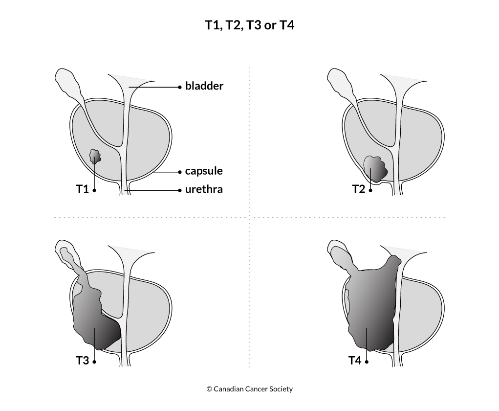 Stages Of Prostate Cancer | Canadian Cancer Society