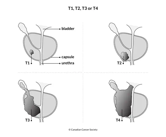 Diagram of T1, T2, T3 or T4