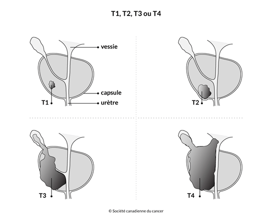 Schéma de T1, T2, T3 ou T4