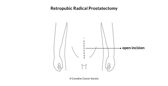 Diagram of retropubic radical prostatectomy