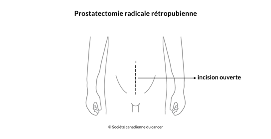 Schéma de la prostatectomie radicale rétropubienne