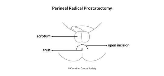 Diagram of perineal radical prostatectomy