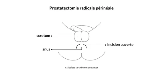 Schéma de la prostatectomie radicale périnéale