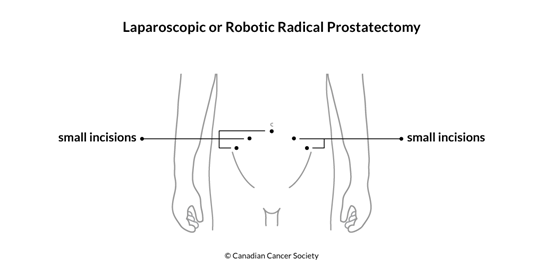 Diagram of laparoscopic or robotic radical prostatectomy