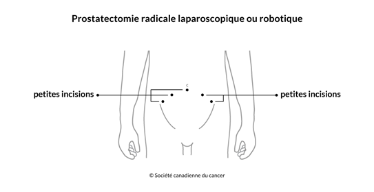 Schéma de la prostatectomie radicale robotique ou laparoscopique