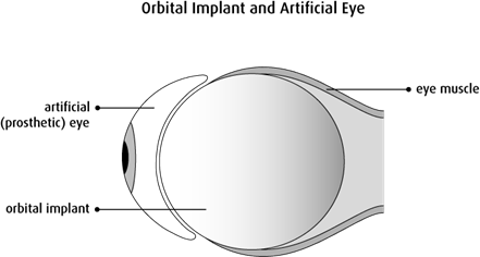 Graphic of an orbital implant and artificial eye