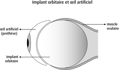 Schéma de l'implant orbitaire et de l'œil artificiel