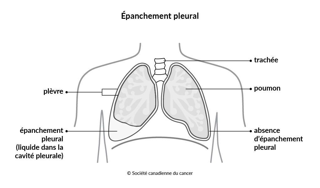 Schéma d'un épanchement pleural