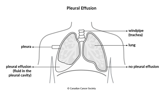 Diagram of pleural effusion