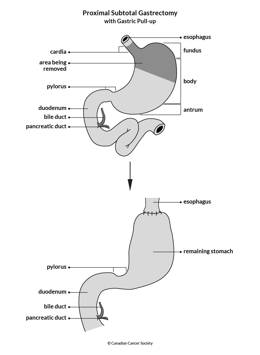 Diagram of a proximal subtotal gastrectomy