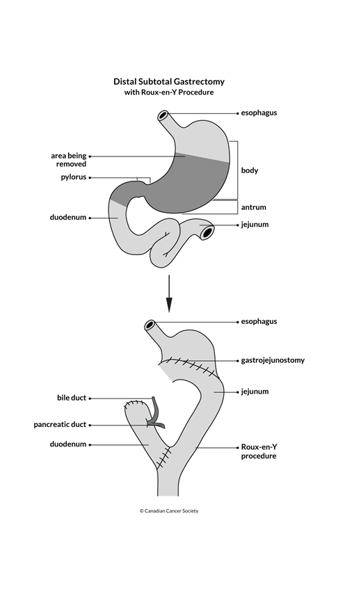 Diagram of a distal subtotal gastrectomy