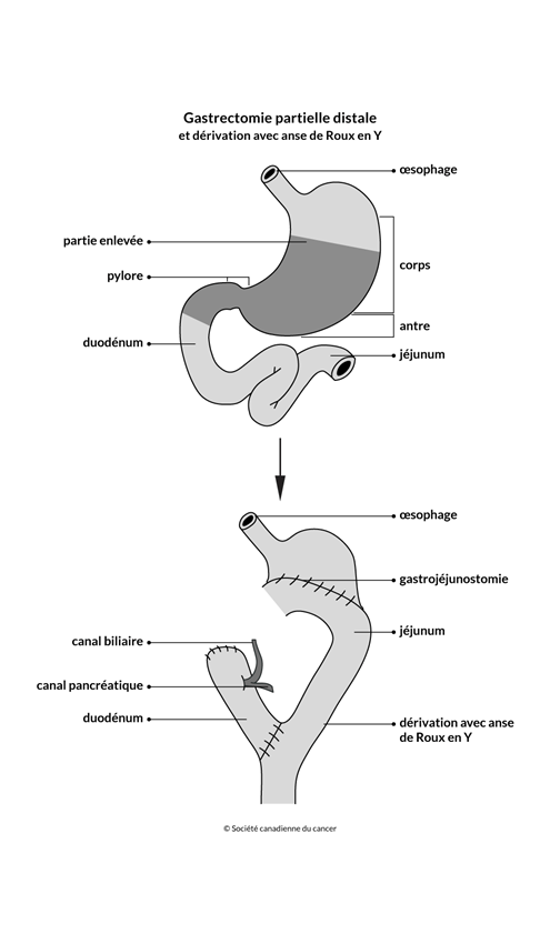Schéma de la gastrectomie partielle distale