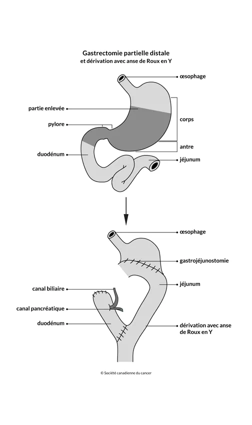 Schéma de la gastrectomie partielle distale