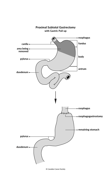Diagram of a proximal subtotal gastrectomy