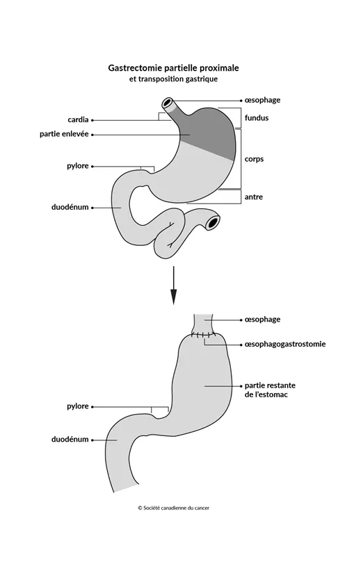 Schéma de la gastrectomie partielle proximale