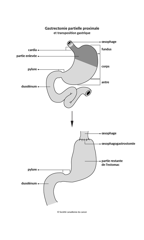 Schéma de la gastrectomie partielle proximale