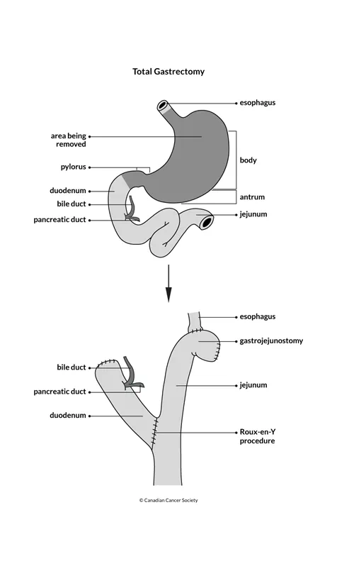 Diagram of a total gastrectomy