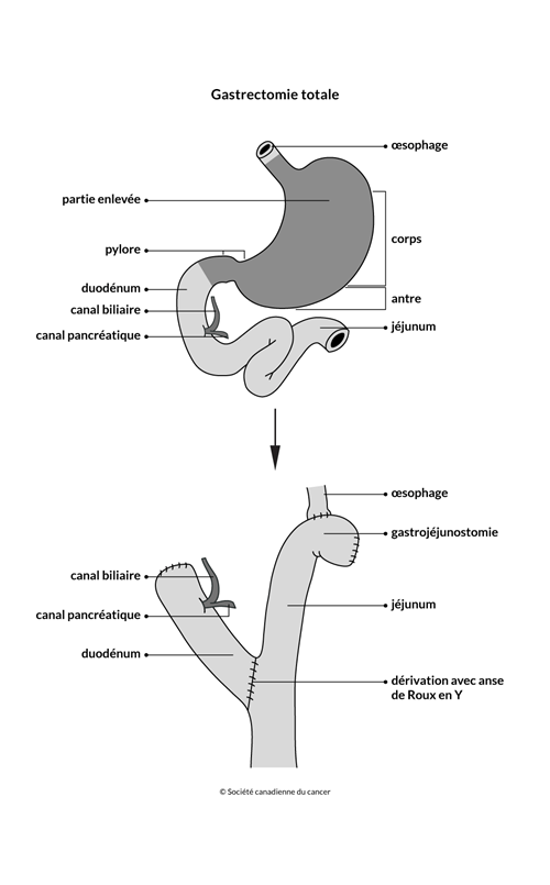 Schéma de la gastrectomie totale