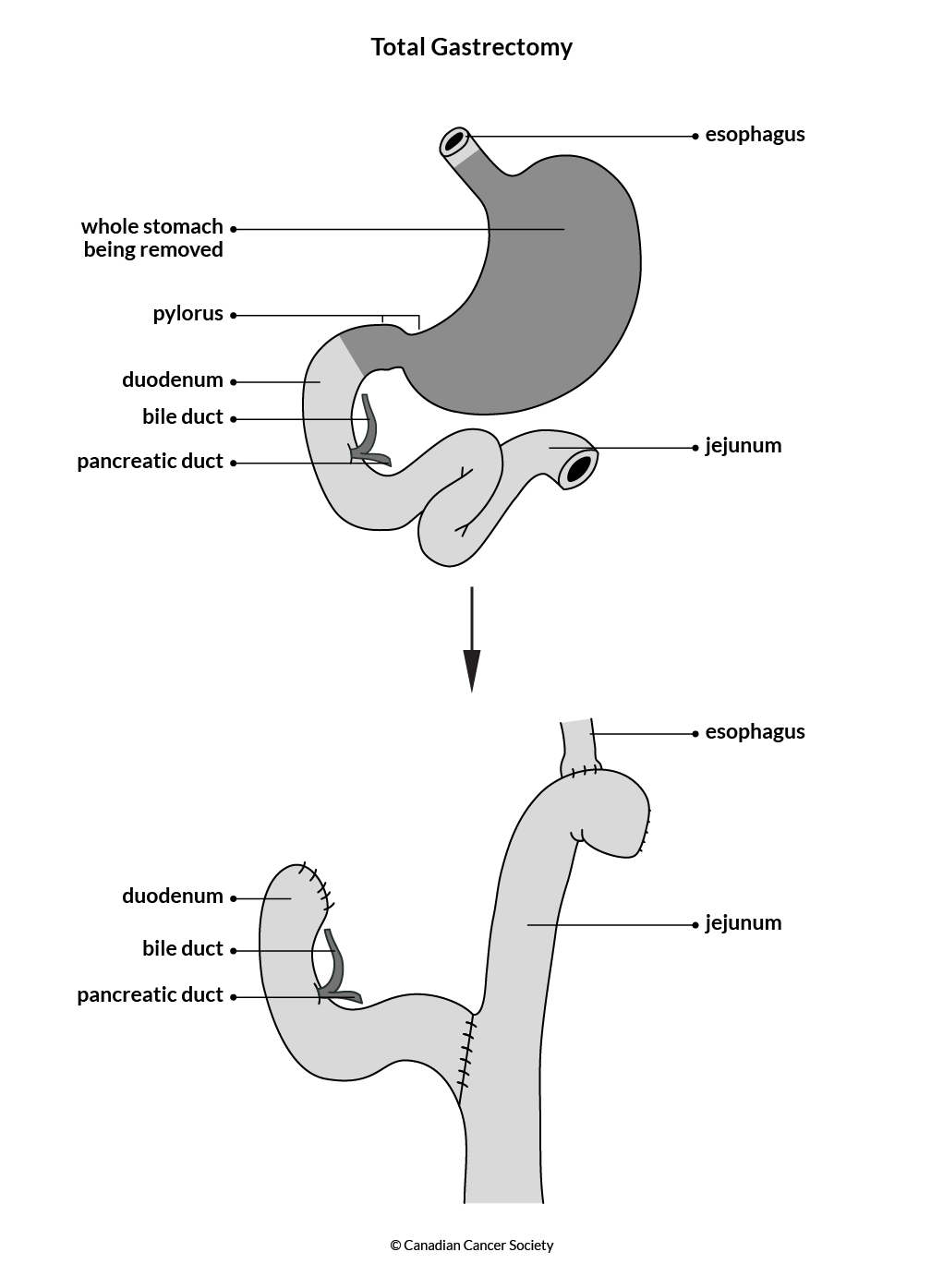 Diagram of a total gastrectomy