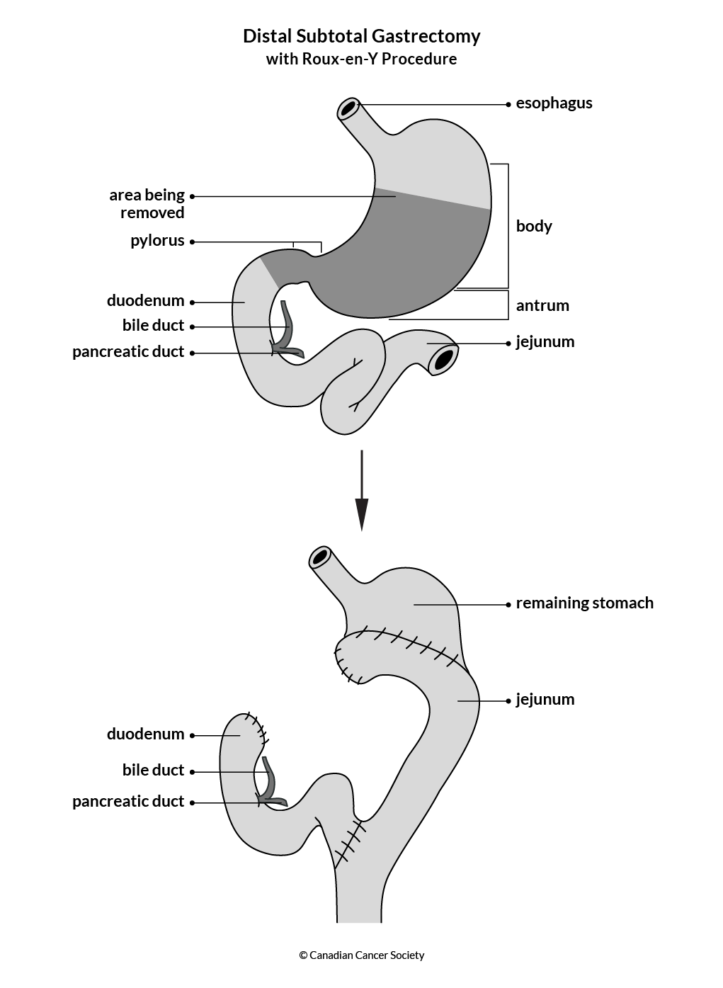 Diagram of a distal subtotal gastrectomy