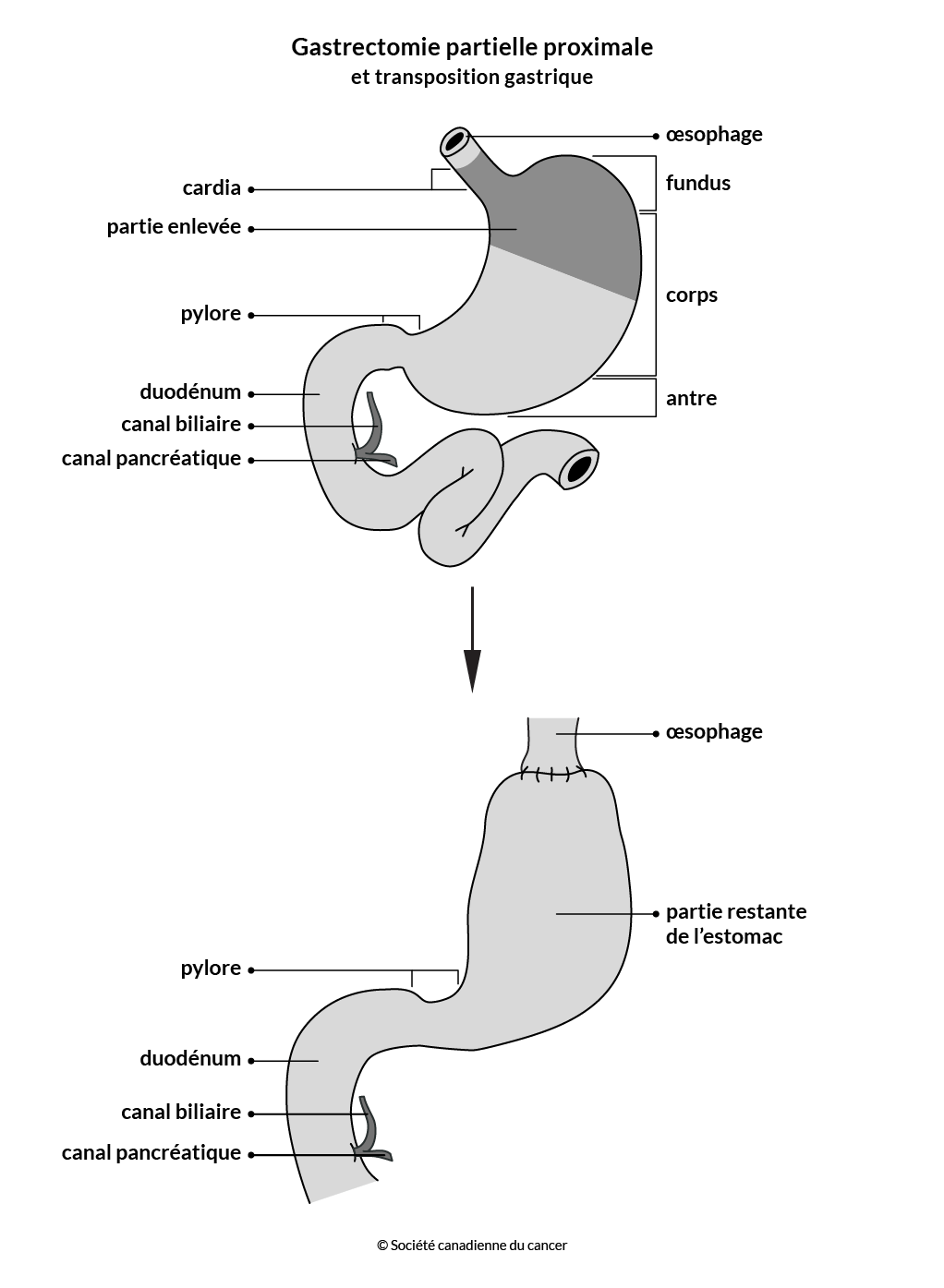 Schéma de la gastrectomie partielle proximale