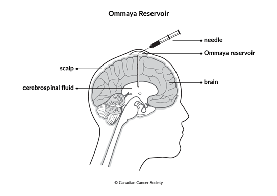 Diagram of Ommaya reservoir
