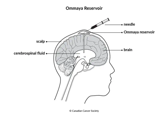 Diagram of Ommaya reservoir